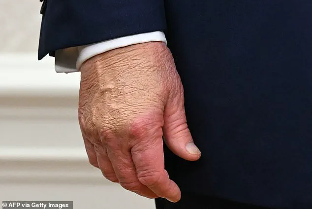 White House Explains New Bruise on President Trump's Hand, Citing Incident at Davos Event