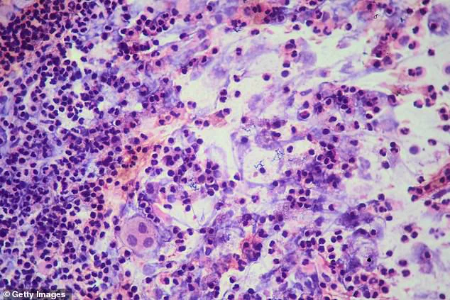 Deadly Tuberculosis Outbreak Forces Archbishop Riordan High School Closure Amid Public Health Crisis, Says SFDPH