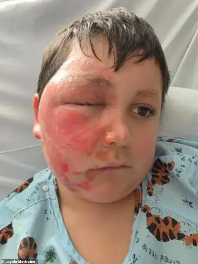 Nine-Year-Old Suffers Severe Burns After Participating in TikTok Microwave Challenge