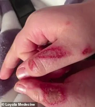 Nine-Year-Old Suffers Severe Burns After Participating in TikTok Microwave Challenge
