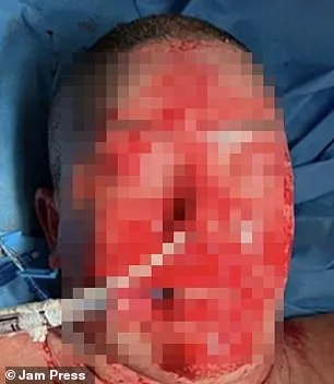 Brazilian Woman Suffers Severe Burns from Rare Drug Reaction