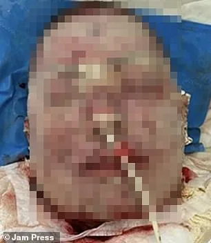 Brazilian Woman Suffers Severe Burns from Rare Drug Reaction