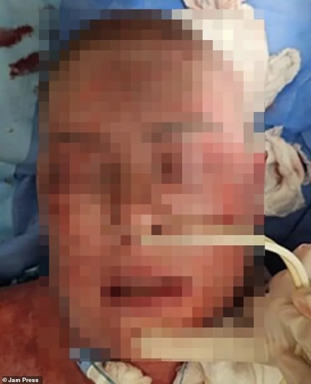 Brazilian Woman Suffers Severe Burns from Rare Drug Reaction