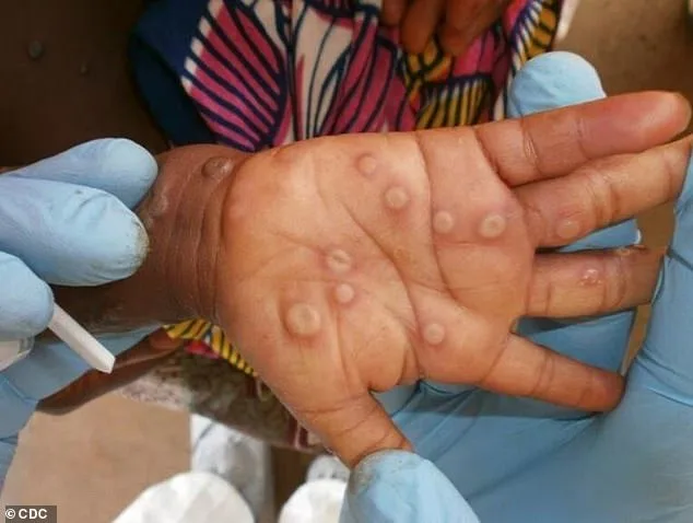 SF Confirms First Case of Deadlier Mpox Strain