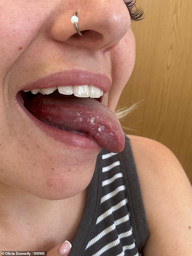 Woman faces tongue removal after oral cancer misdiagnosed as rare condition