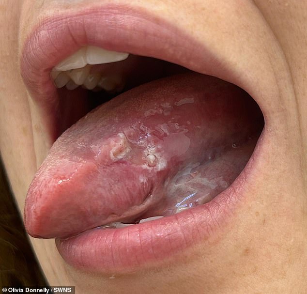 Woman faces tongue removal after oral cancer misdiagnosed as rare condition