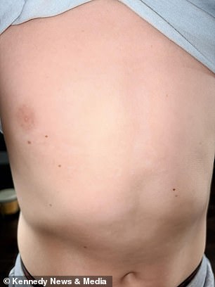 Giant hogweed toy axe leaves Kent boy with severe burns.