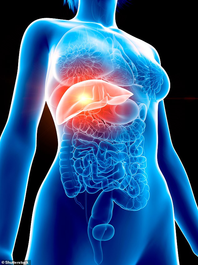 Fatty Liver Disease Significantly Increases Risk of Aggressive Bowel Cancer