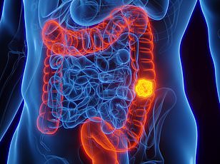 Fatty Liver Disease Significantly Increases Risk of Aggressive Bowel Cancer